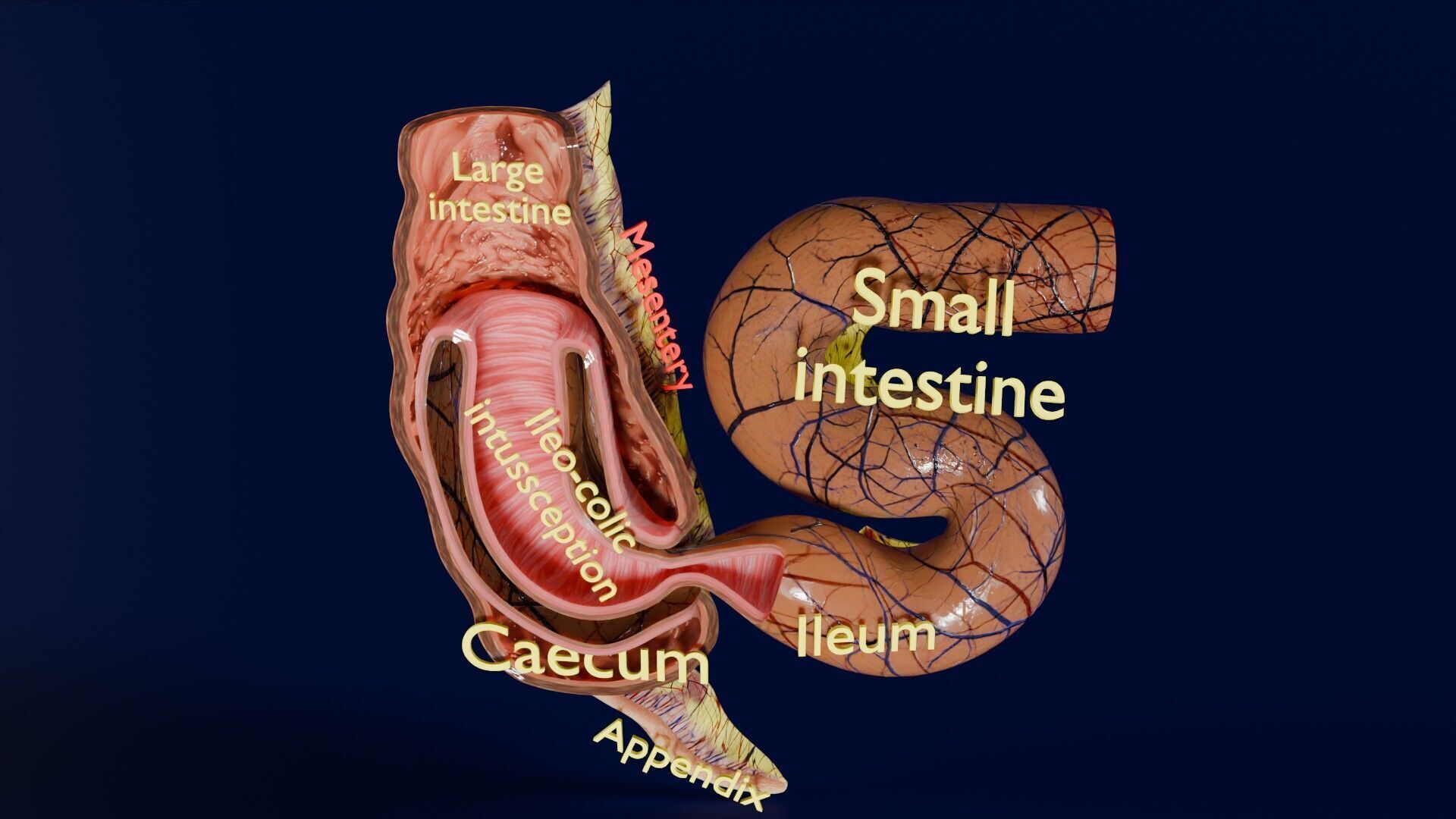 Intussusception intestine ileocolic obstruction Low-poly 3D model_48