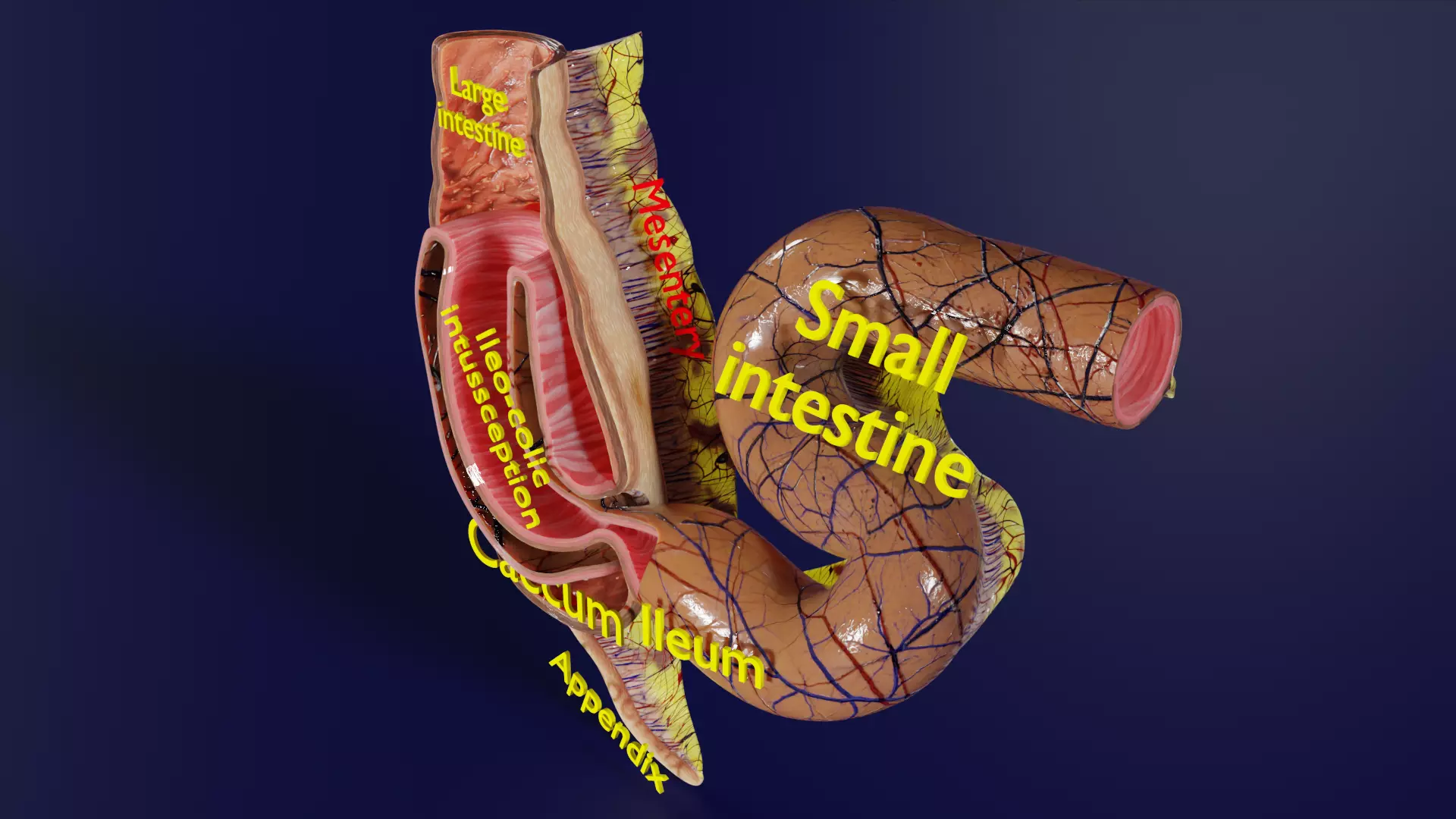 Intussusception intestine ileocolic obstruction Low-poly 3D model_0