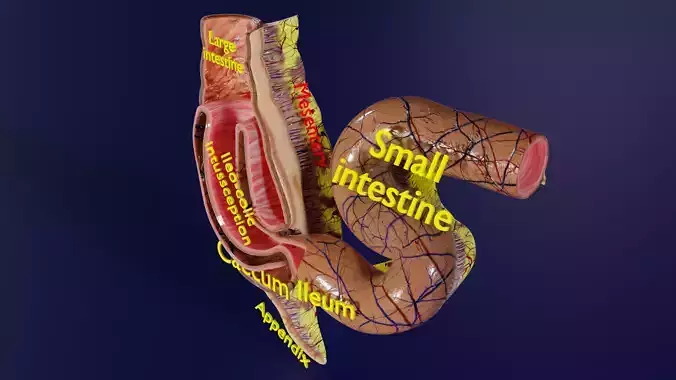 Intussusception intestine ileocolic obstruction
