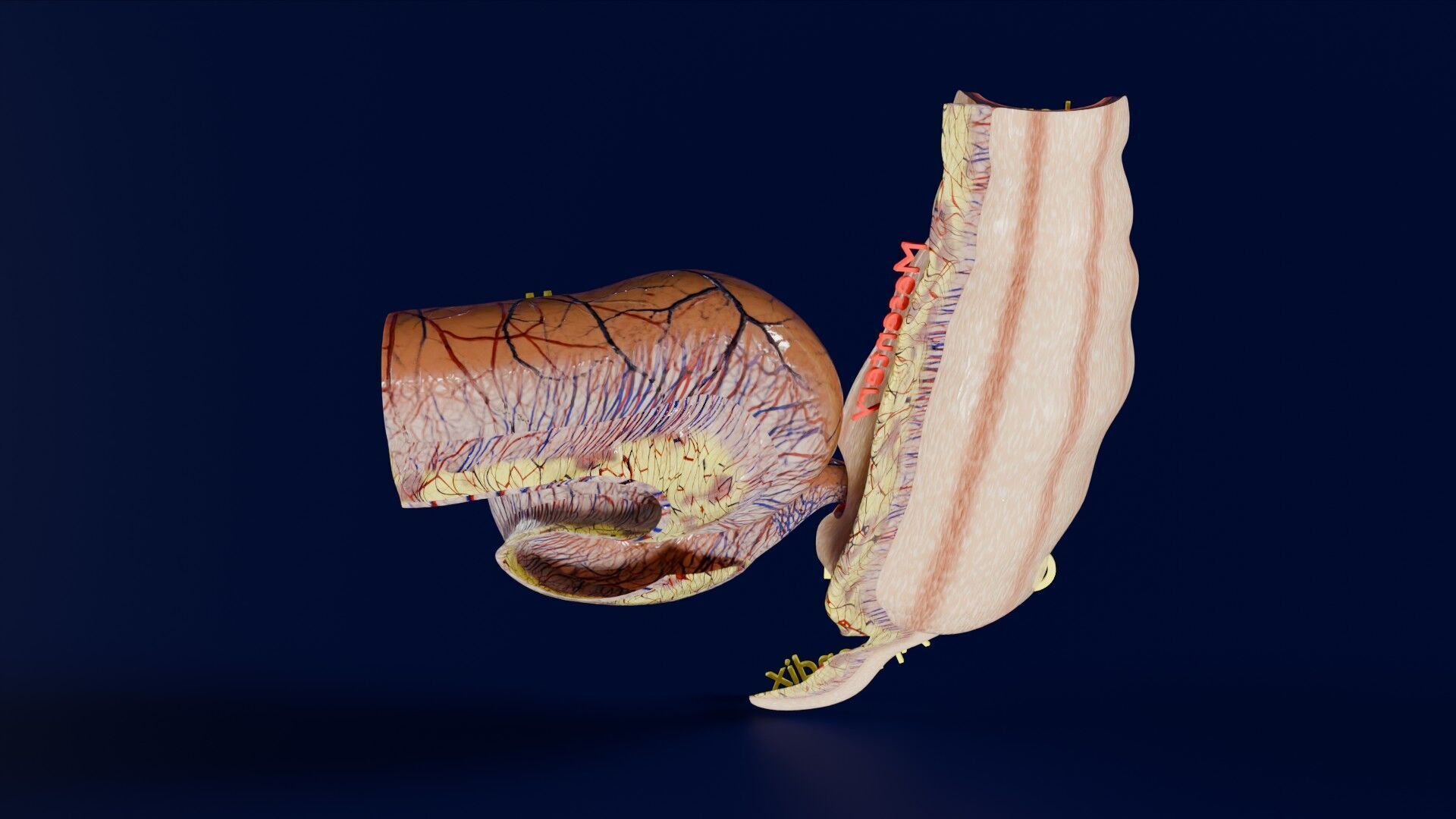 Intussusception intestine ileocolic obstruction Low-poly 3D model_33