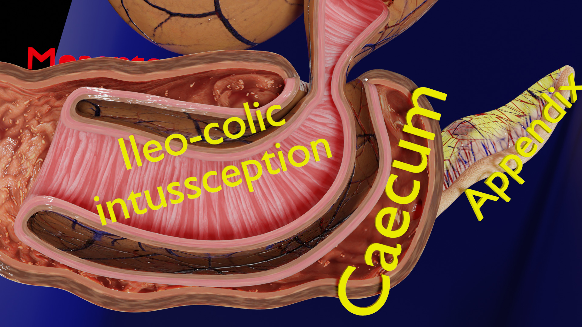 Intussusception intestine ileocolic obstruction Low-poly 3D model_10