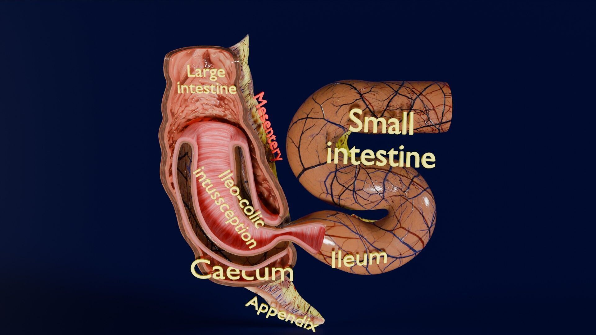 Intussusception intestine ileocolic obstruction Low-poly 3D model_49