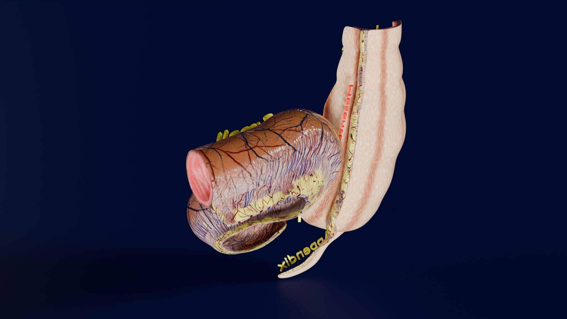 Intussusception intestine ileocolic obstruction Low-poly 3D model_35