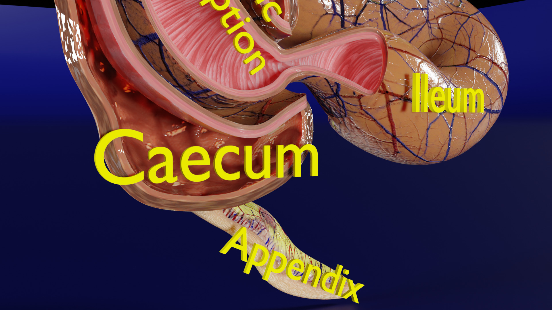 Intussusception intestine ileocolic obstruction Low-poly 3D model_4