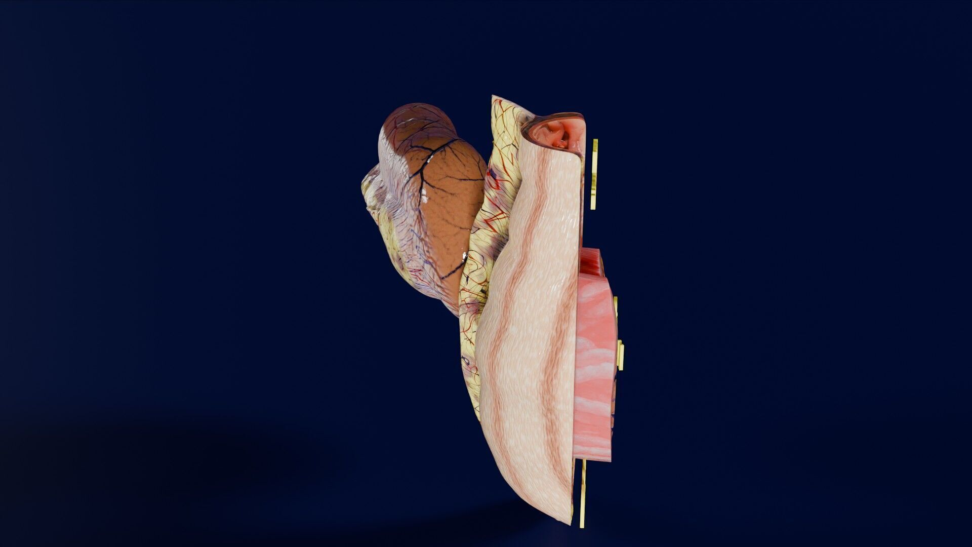 Intussusception intestine ileocolic obstruction Low-poly 3D model_27
