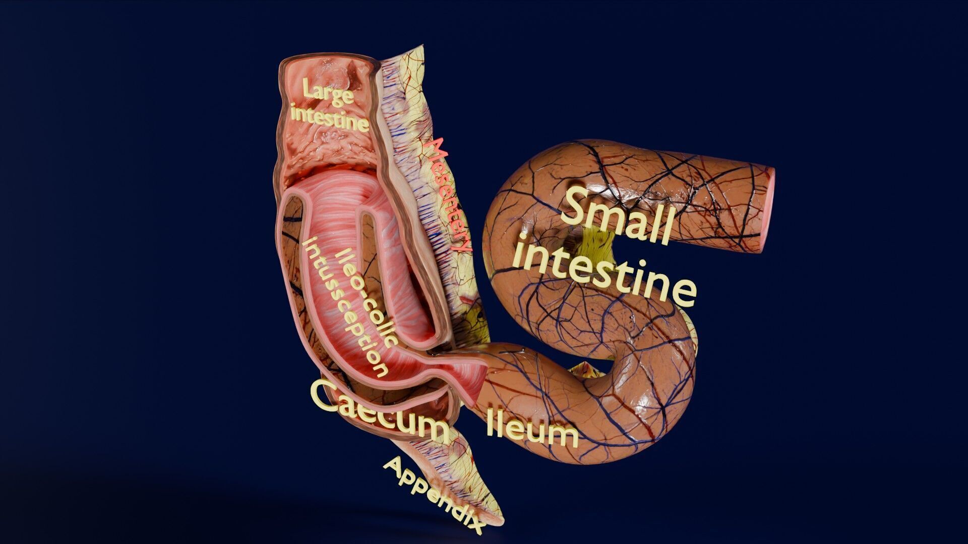 Intussusception intestine ileocolic obstruction Low-poly 3D model_45