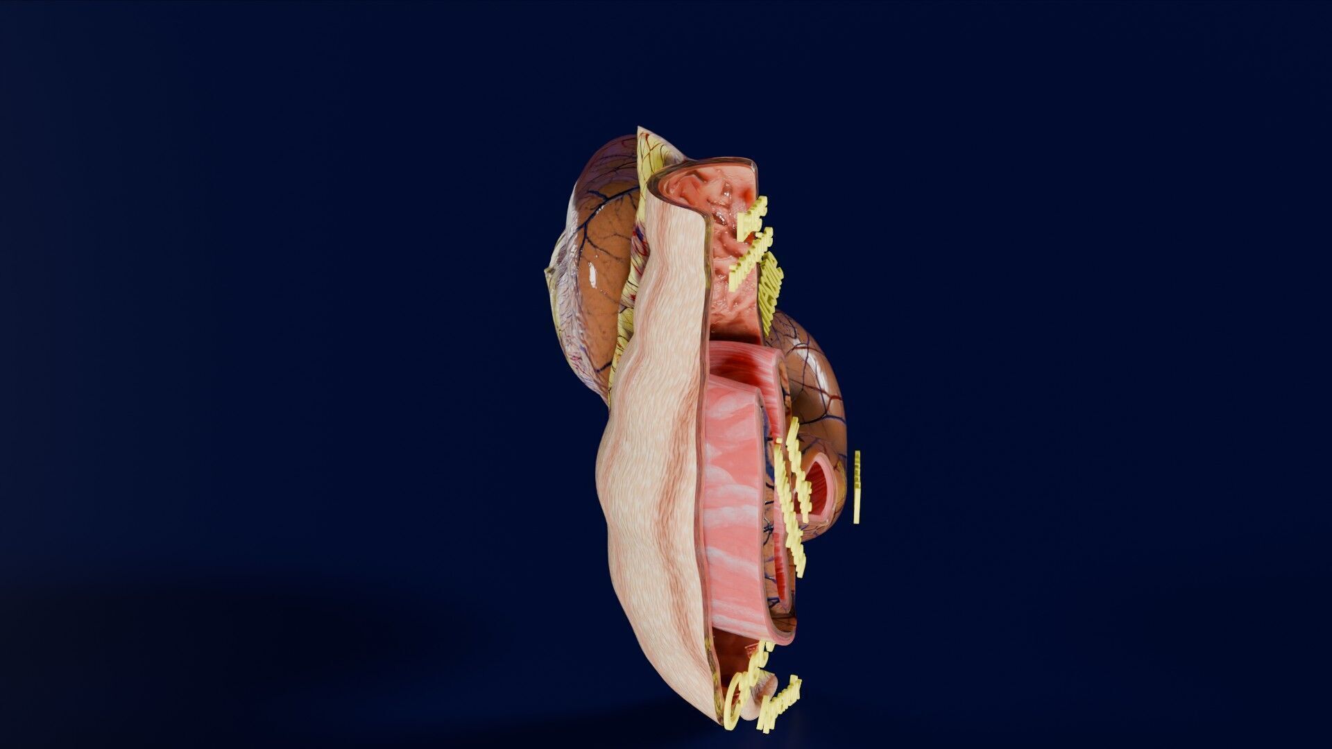 Intussusception intestine ileocolic obstruction Low-poly 3D model_26