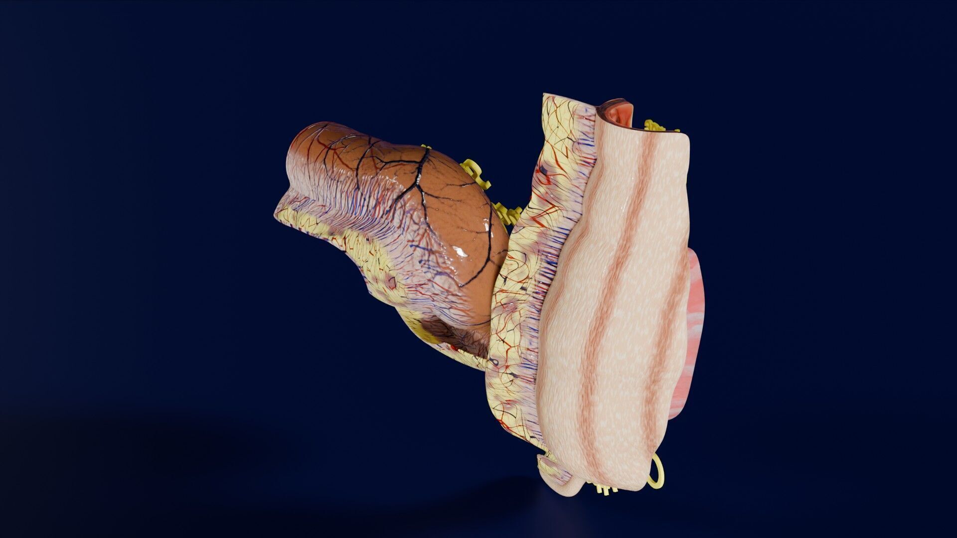 Intussusception intestine ileocolic obstruction Low-poly 3D model_29