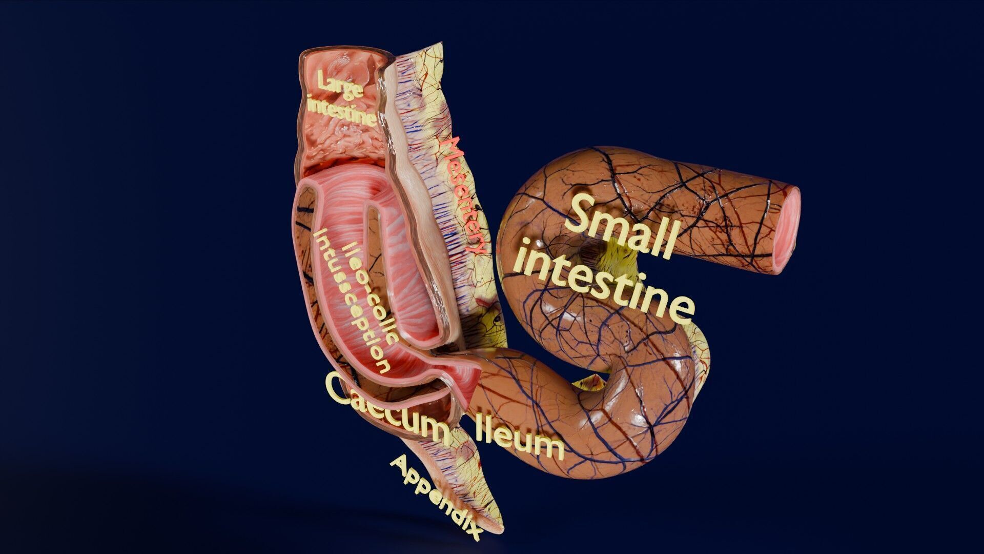Intussusception intestine ileocolic obstruction Low-poly 3D model_44