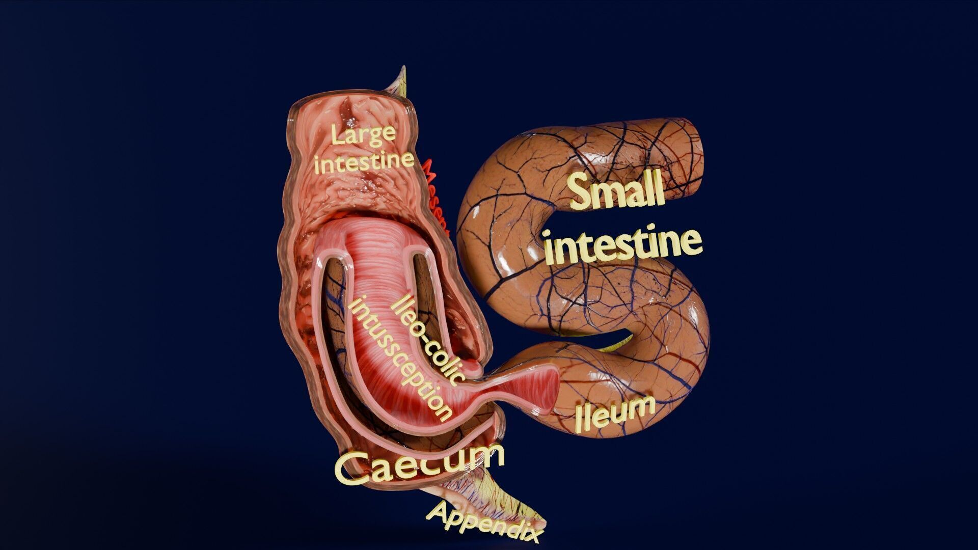Intussusception intestine ileocolic obstruction Low-poly 3D model_20