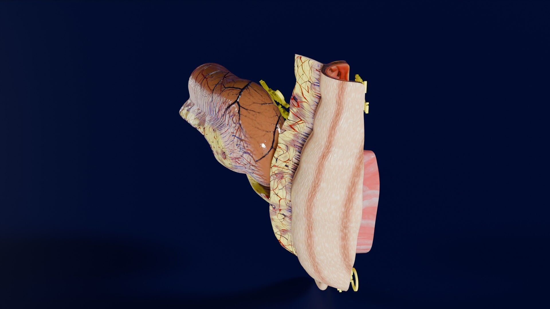 Intussusception intestine ileocolic obstruction Low-poly 3D model_28