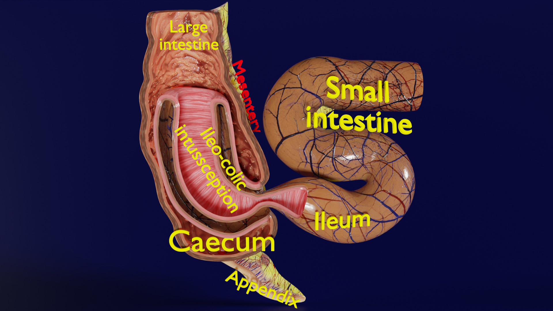Intussusception intestine ileocolic obstruction Low-poly 3D model_2