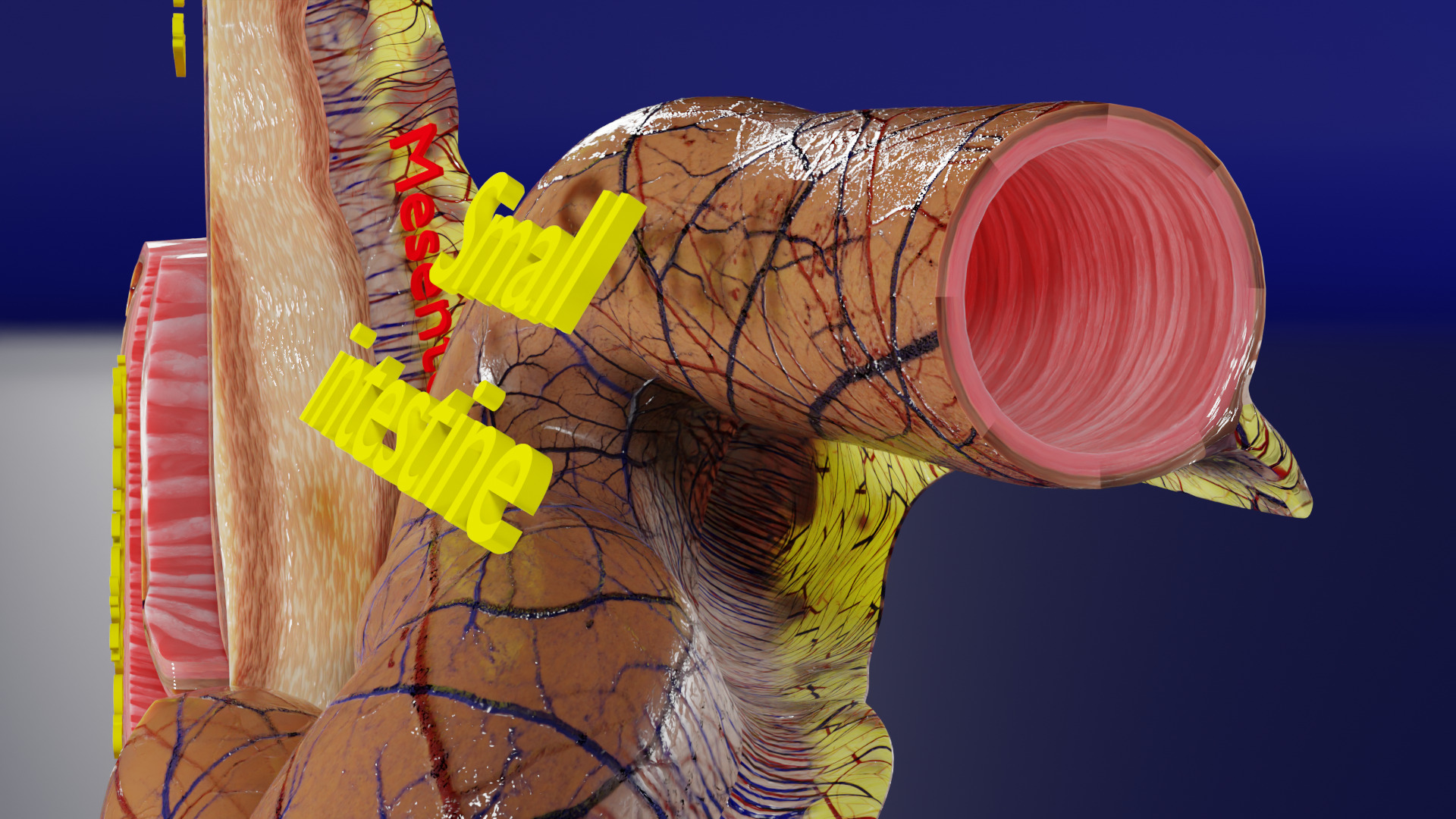 Intussusception intestine ileocolic obstruction Low-poly 3D model_7