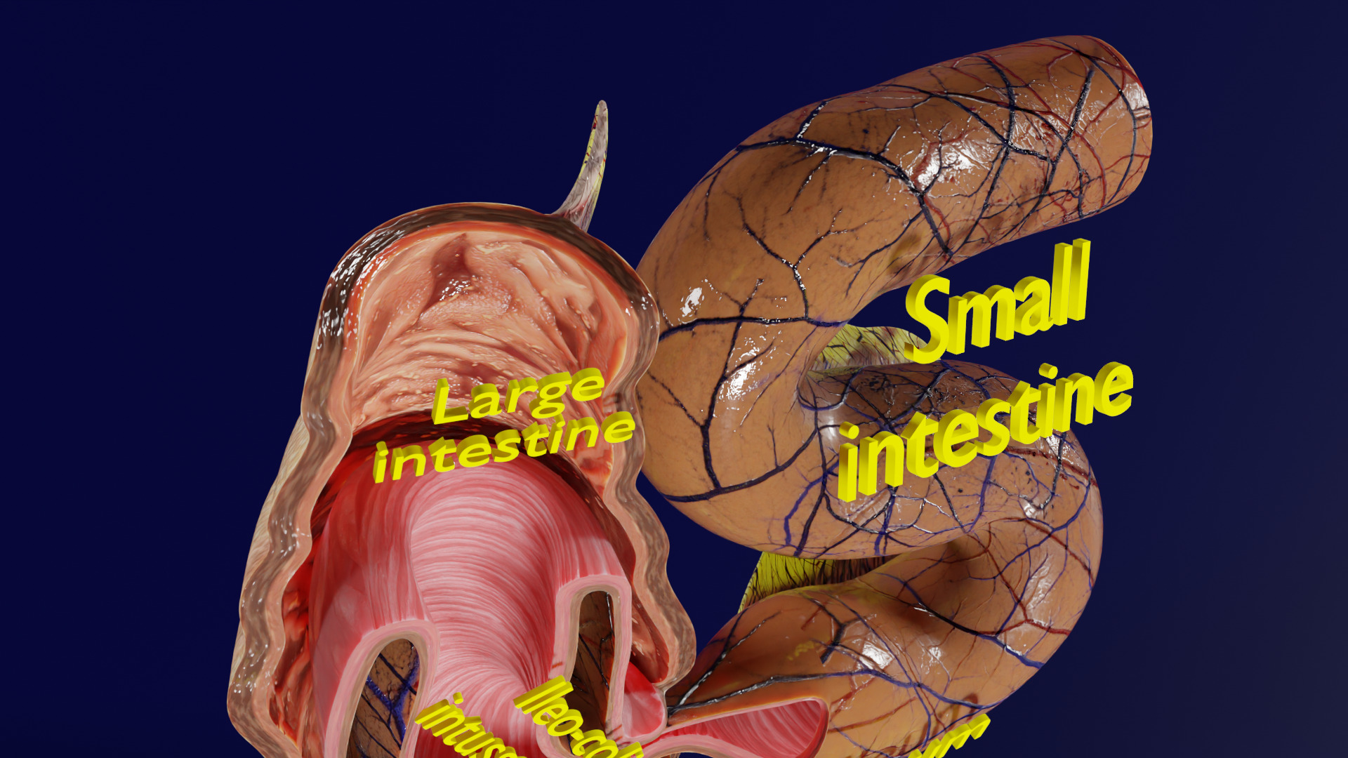 Intussusception intestine ileocolic obstruction Low-poly 3D model_15
