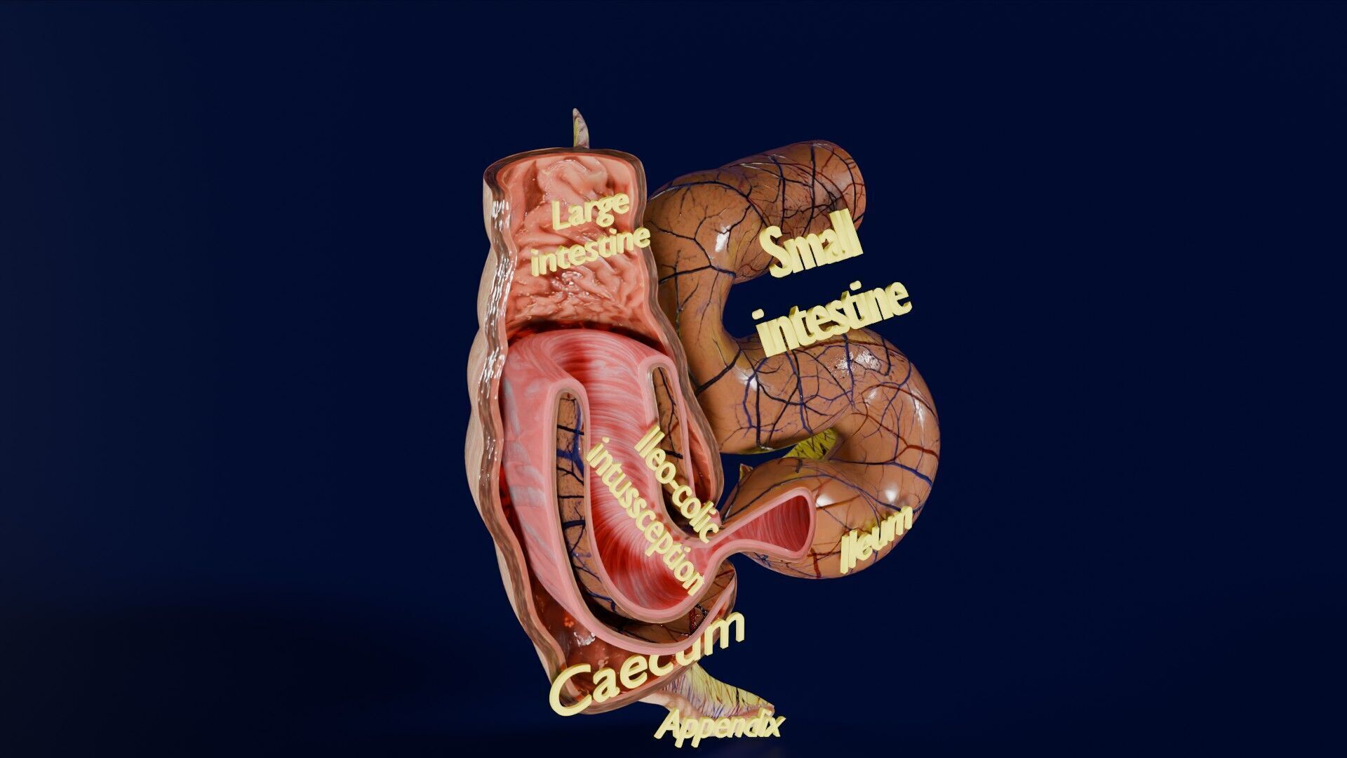 Intussusception intestine ileocolic obstruction Low-poly 3D model_23