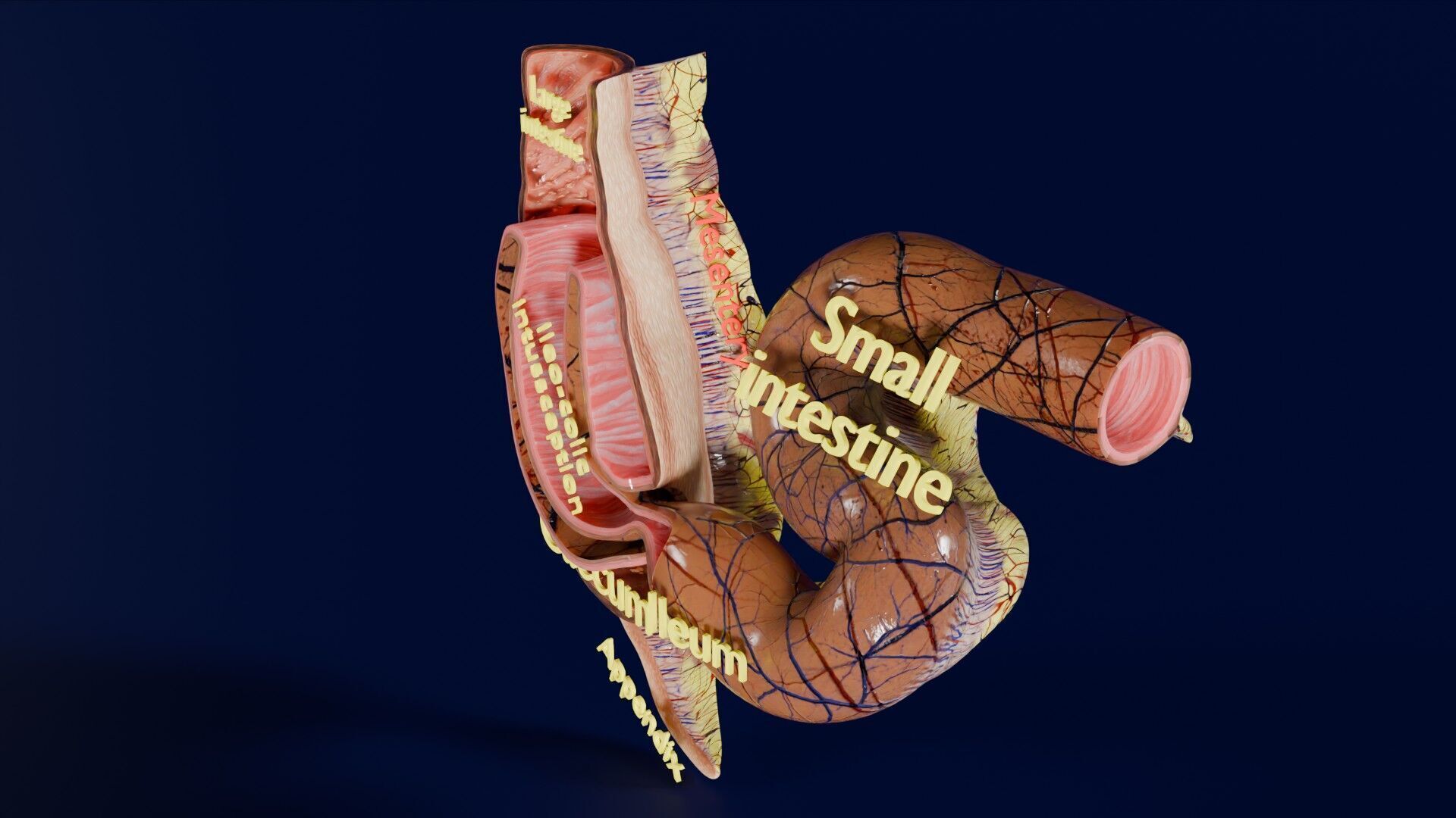 Intussusception intestine ileocolic obstruction Low-poly 3D model_42