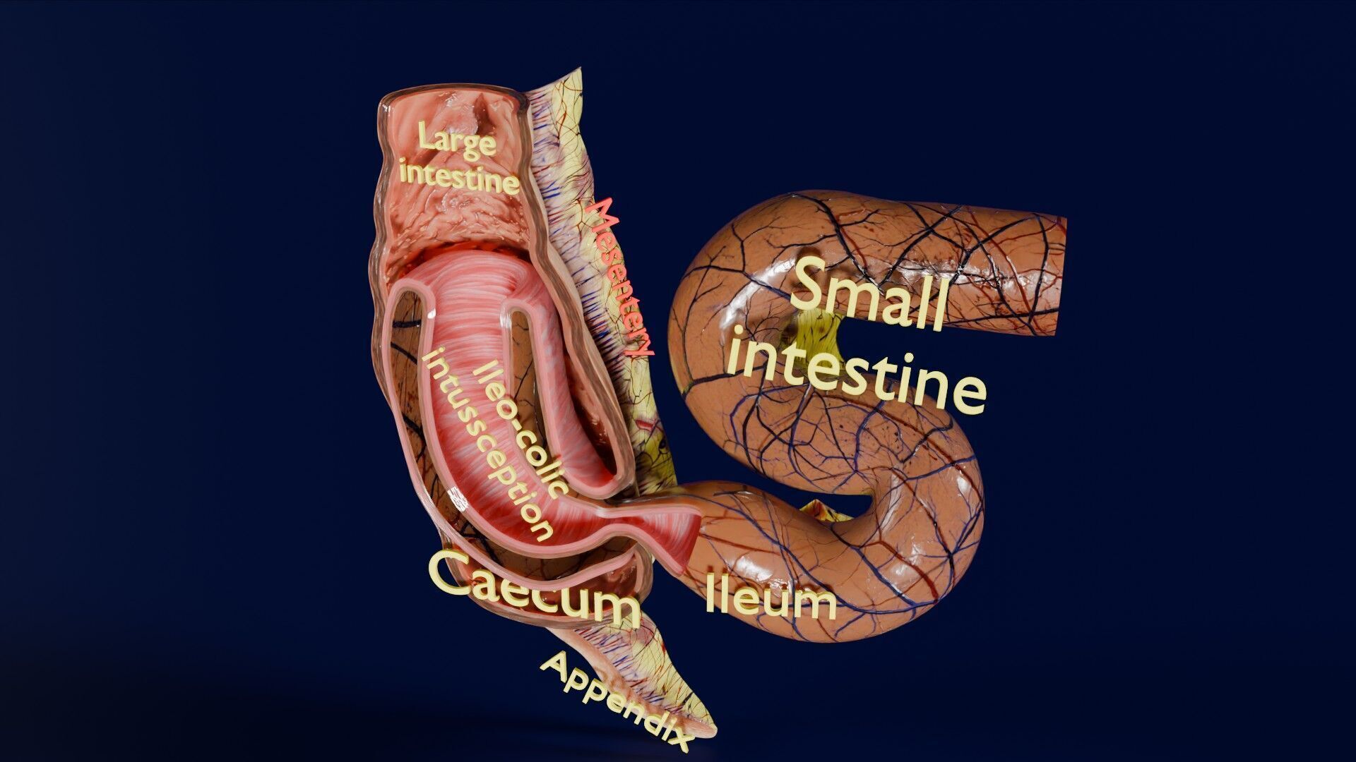 Intussusception intestine ileocolic obstruction Low-poly 3D model_46