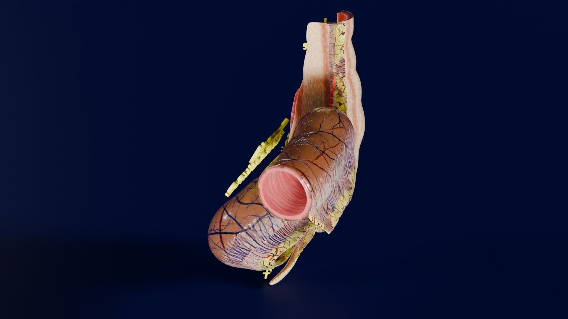 Intussusception intestine ileocolic obstruction Low-poly 3D model_37