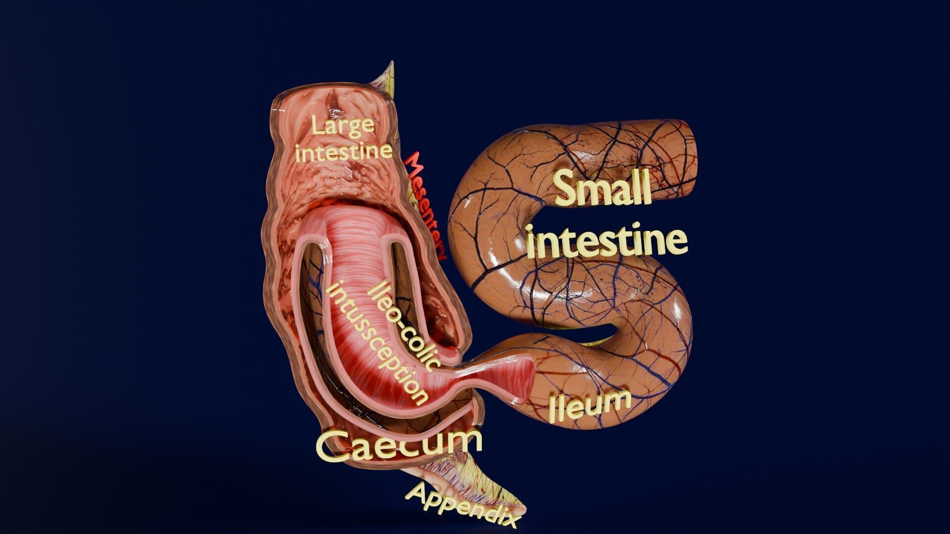 Intussusception intestine ileocolic obstruction Low-poly 3D model_19