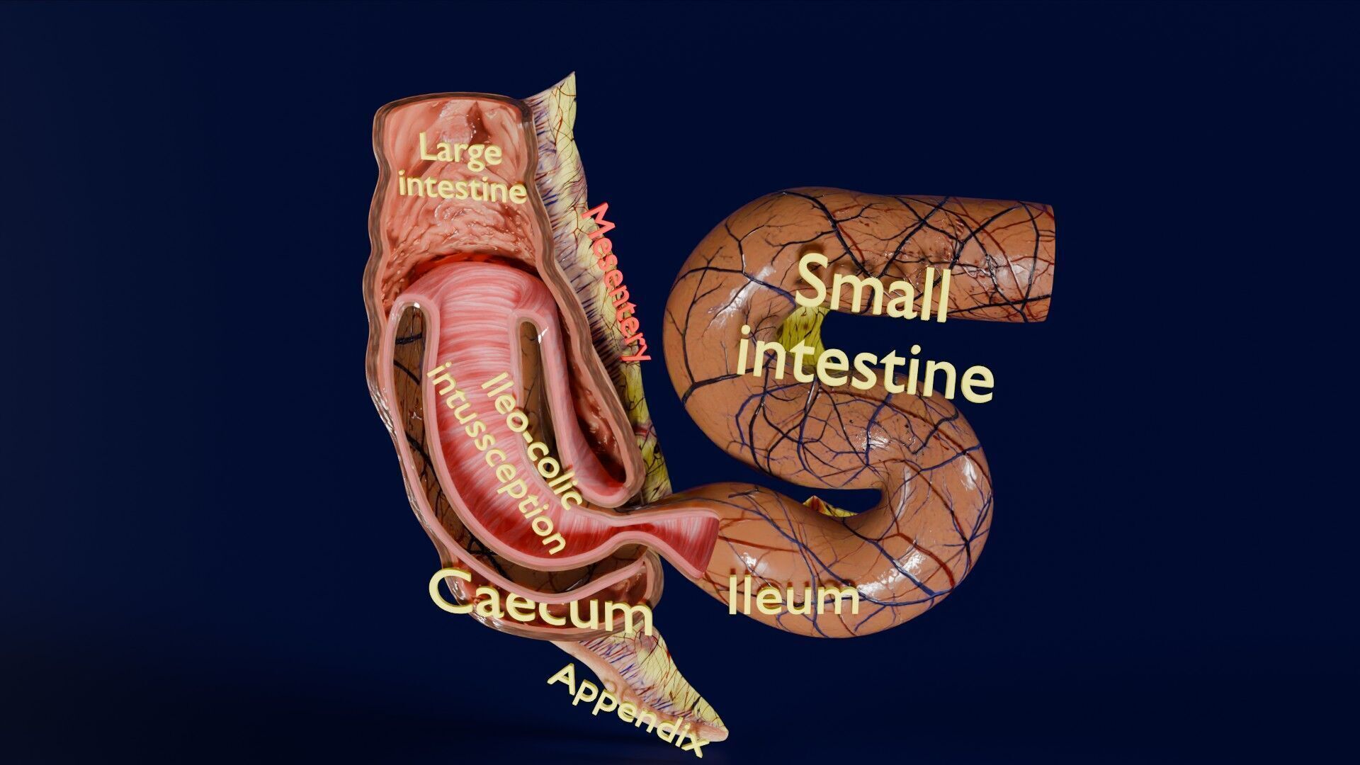 Intussusception intestine ileocolic obstruction Low-poly 3D model_47