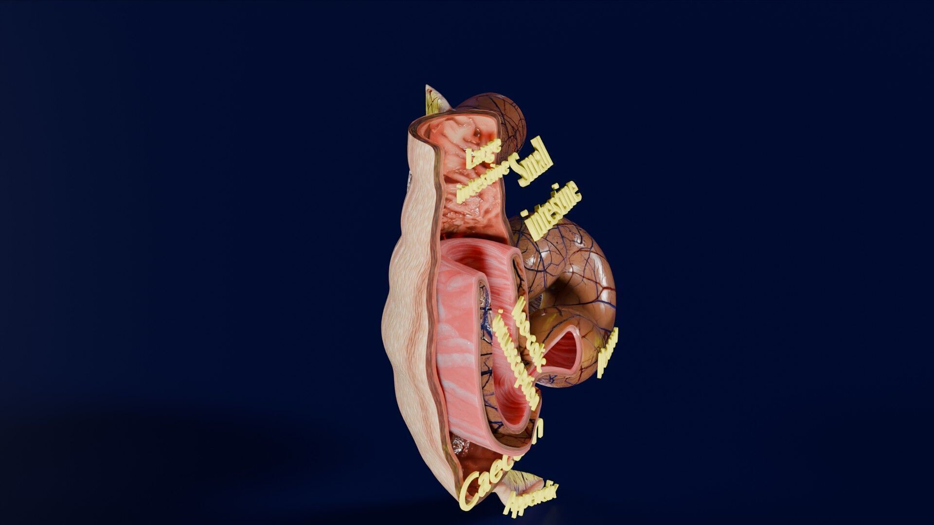 Intussusception intestine ileocolic obstruction Low-poly 3D model_25