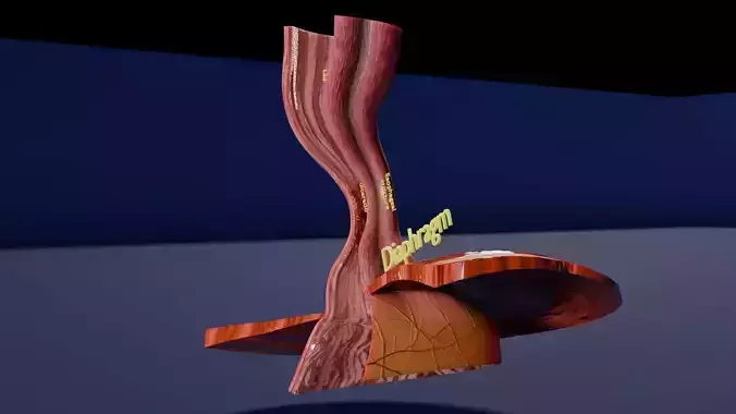 Gastro oesophageal reflux disease Low-poly 3D model
