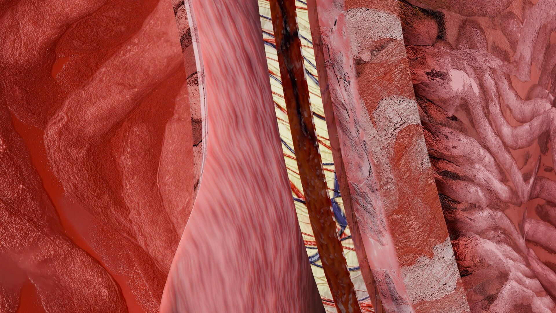 Hiatal hernia stomach sliding paraesophageal Low-poly 3D model_12