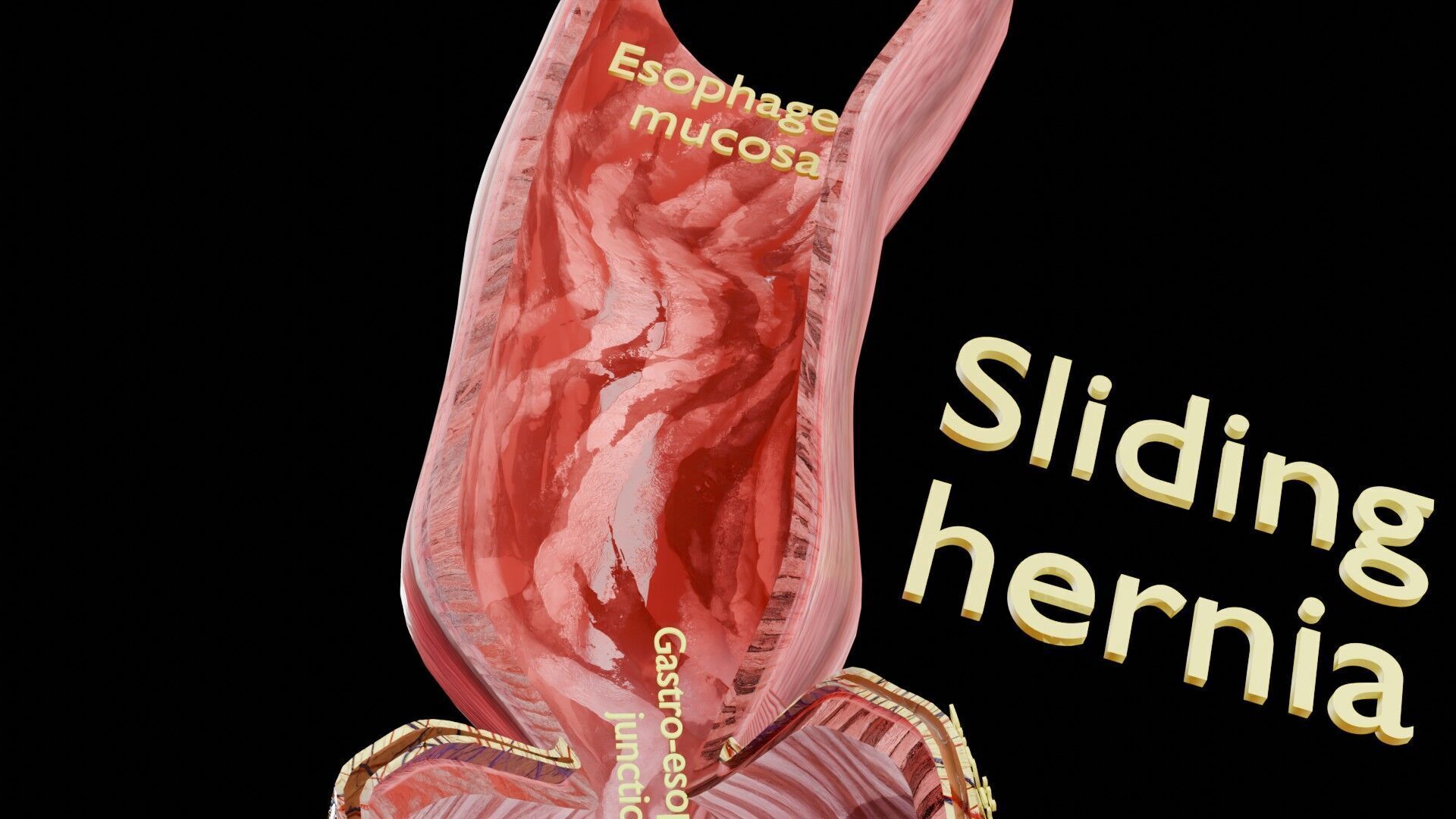 Hiatal hernia stomach sliding paraesophageal Low-poly 3D model_25