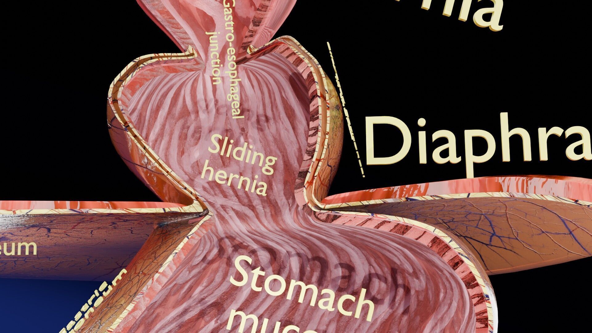 Hiatal hernia stomach sliding paraesophageal Low-poly 3D model_22