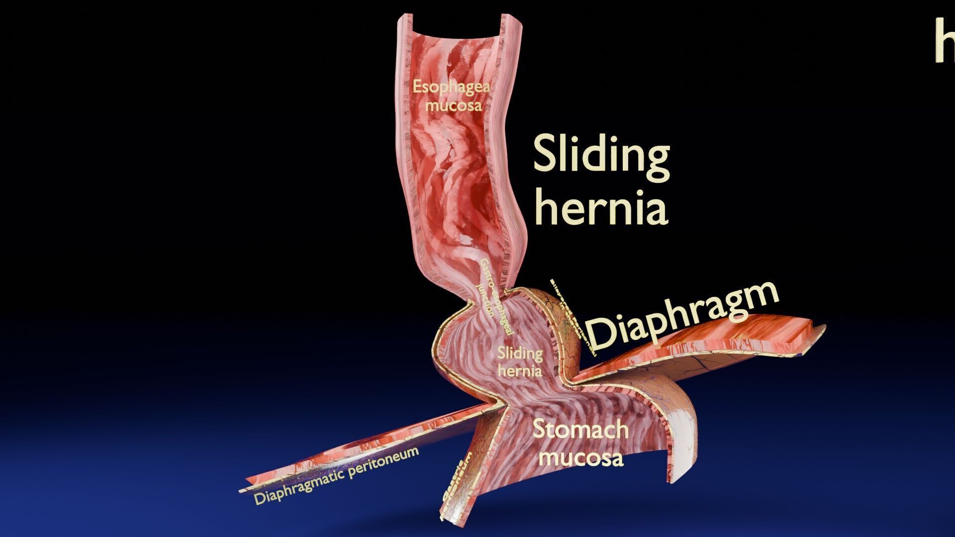 Hiatal hernia stomach sliding paraesophageal Low-poly 3D model_26