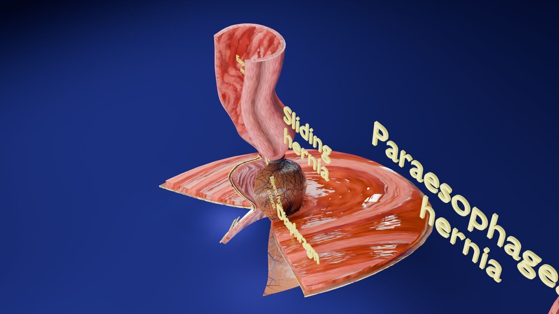 Hiatal hernia stomach sliding paraesophageal Low-poly 3D model_28