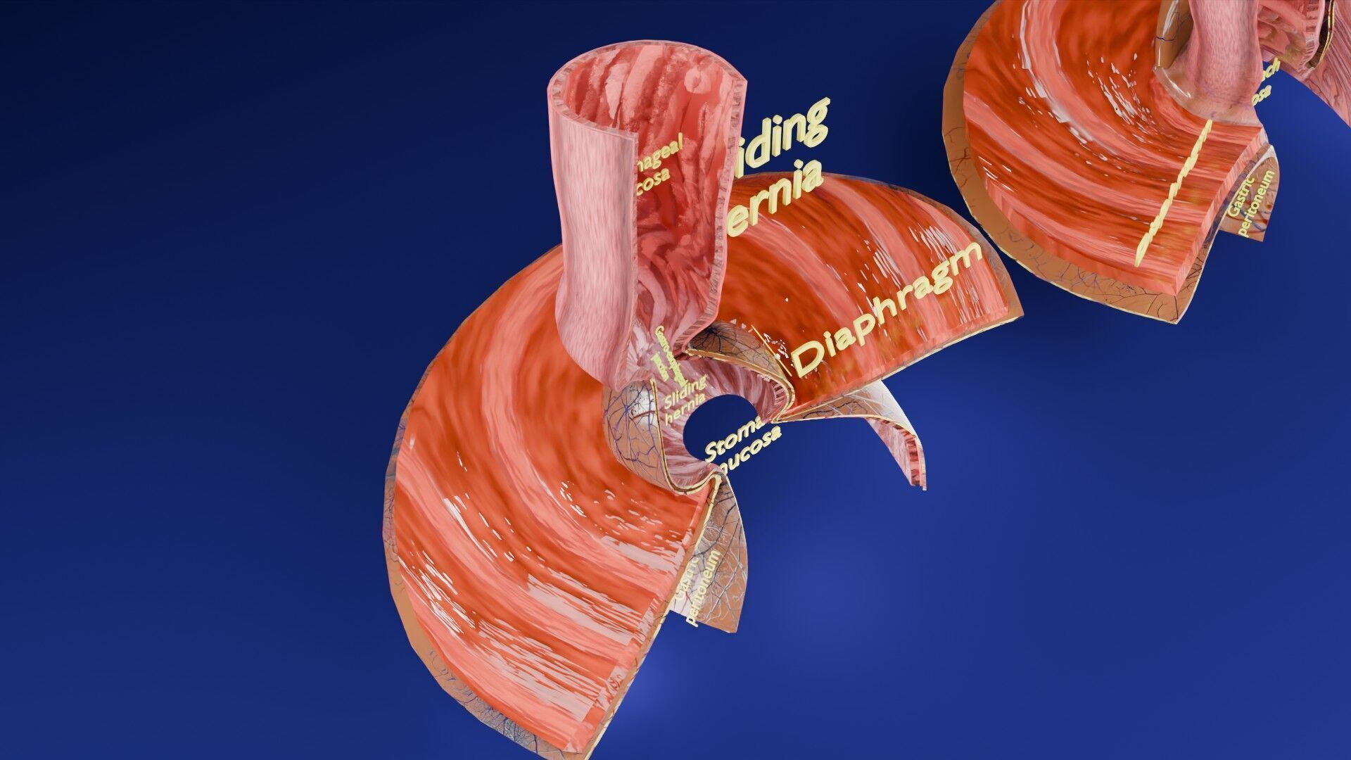 Hiatal hernia stomach sliding paraesophageal Low-poly 3D model_29
