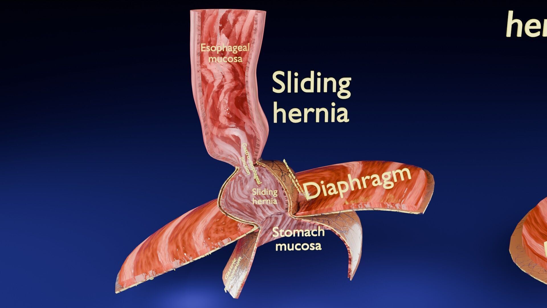 Hiatal hernia stomach sliding paraesophageal Low-poly 3D model_18