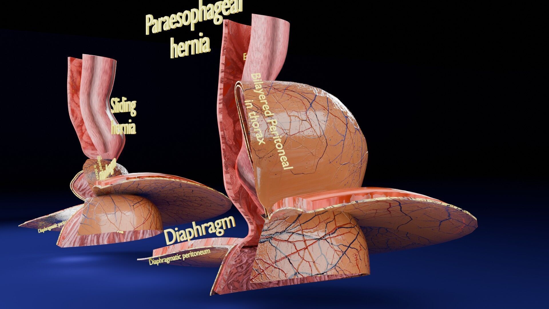 Hiatal hernia stomach sliding paraesophageal Low-poly 3D model_14