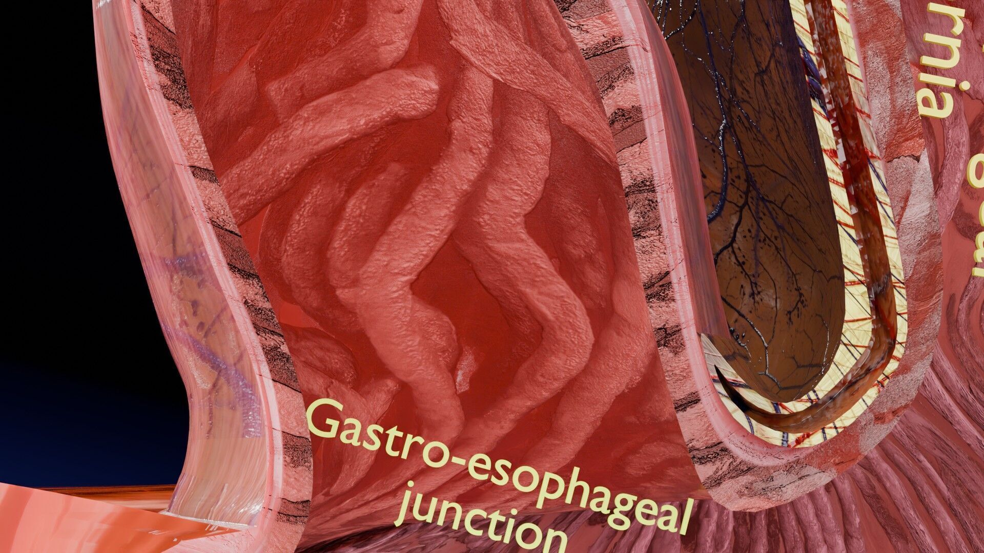 Hiatal hernia stomach sliding paraesophageal Low-poly 3D model_9