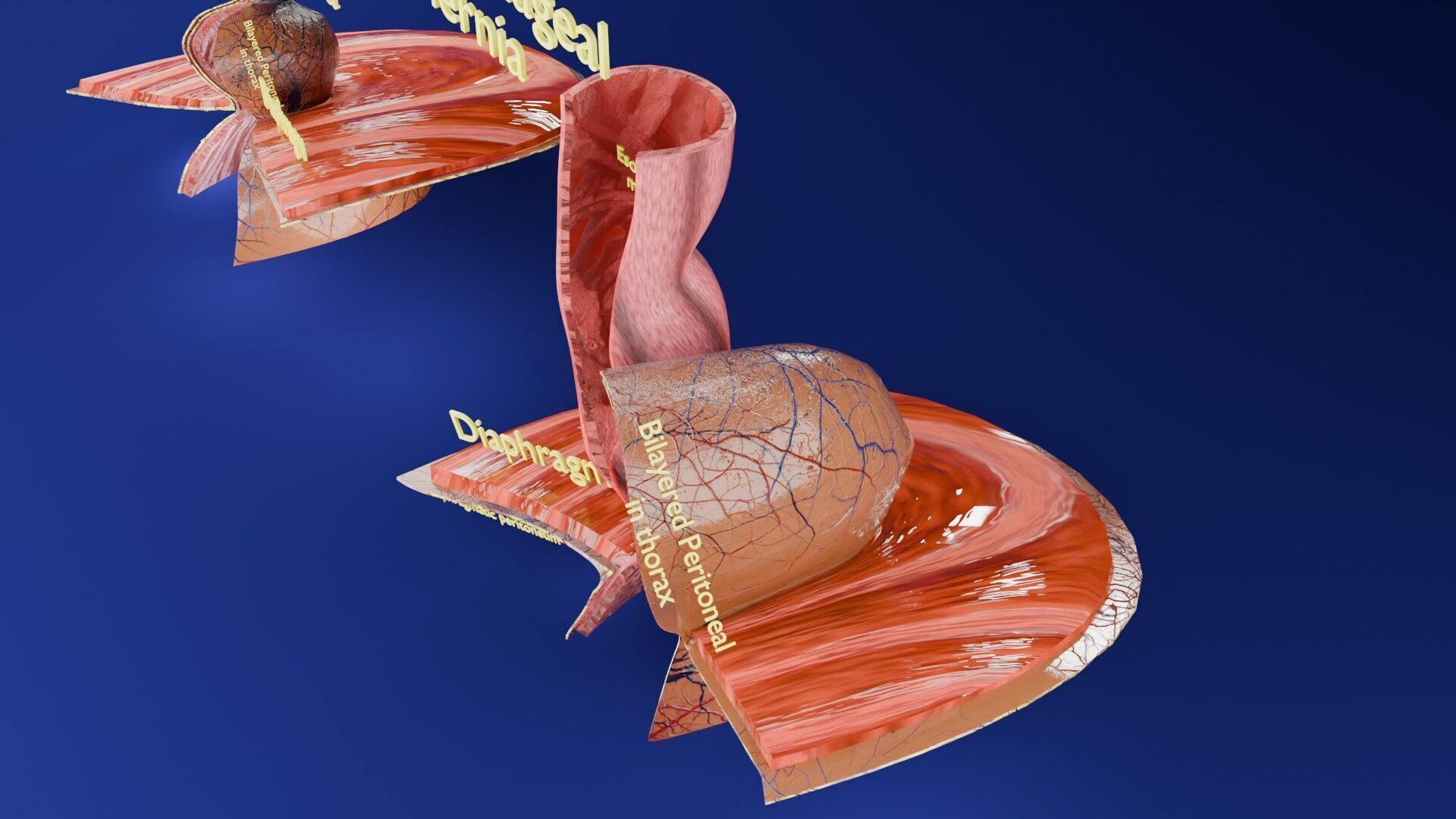 Hiatal hernia stomach sliding paraesophageal Low-poly 3D model_15