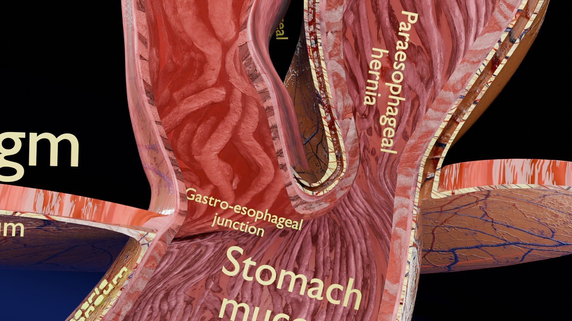 Hiatal hernia stomach sliding paraesophageal Low-poly 3D model_8
