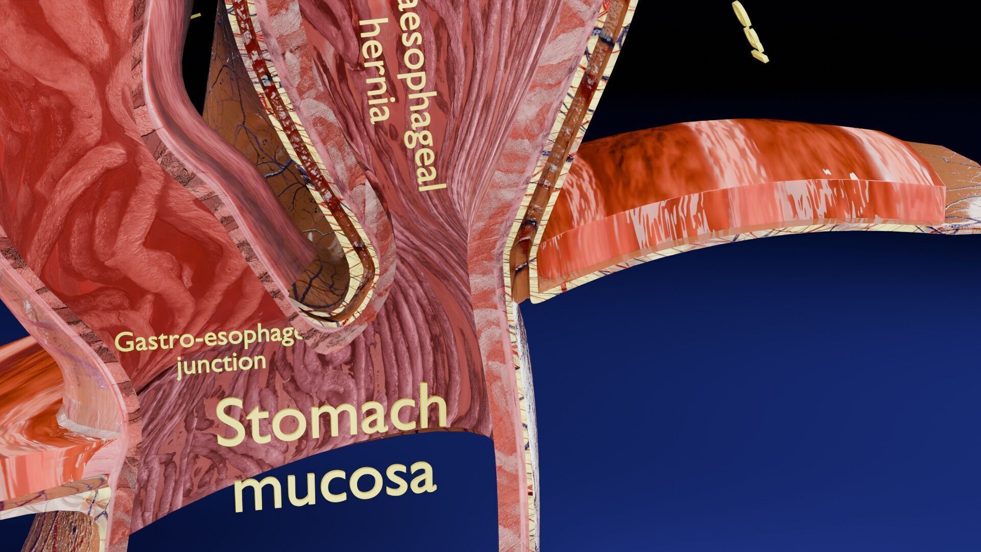 Hiatal hernia stomach sliding paraesophageal Low-poly 3D model_7