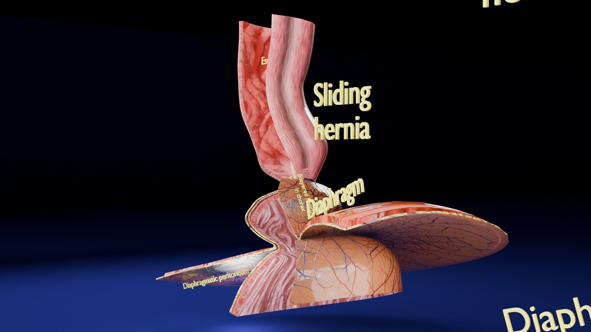 Hiatal hernia stomach sliding paraesophageal Low-poly 3D model_27