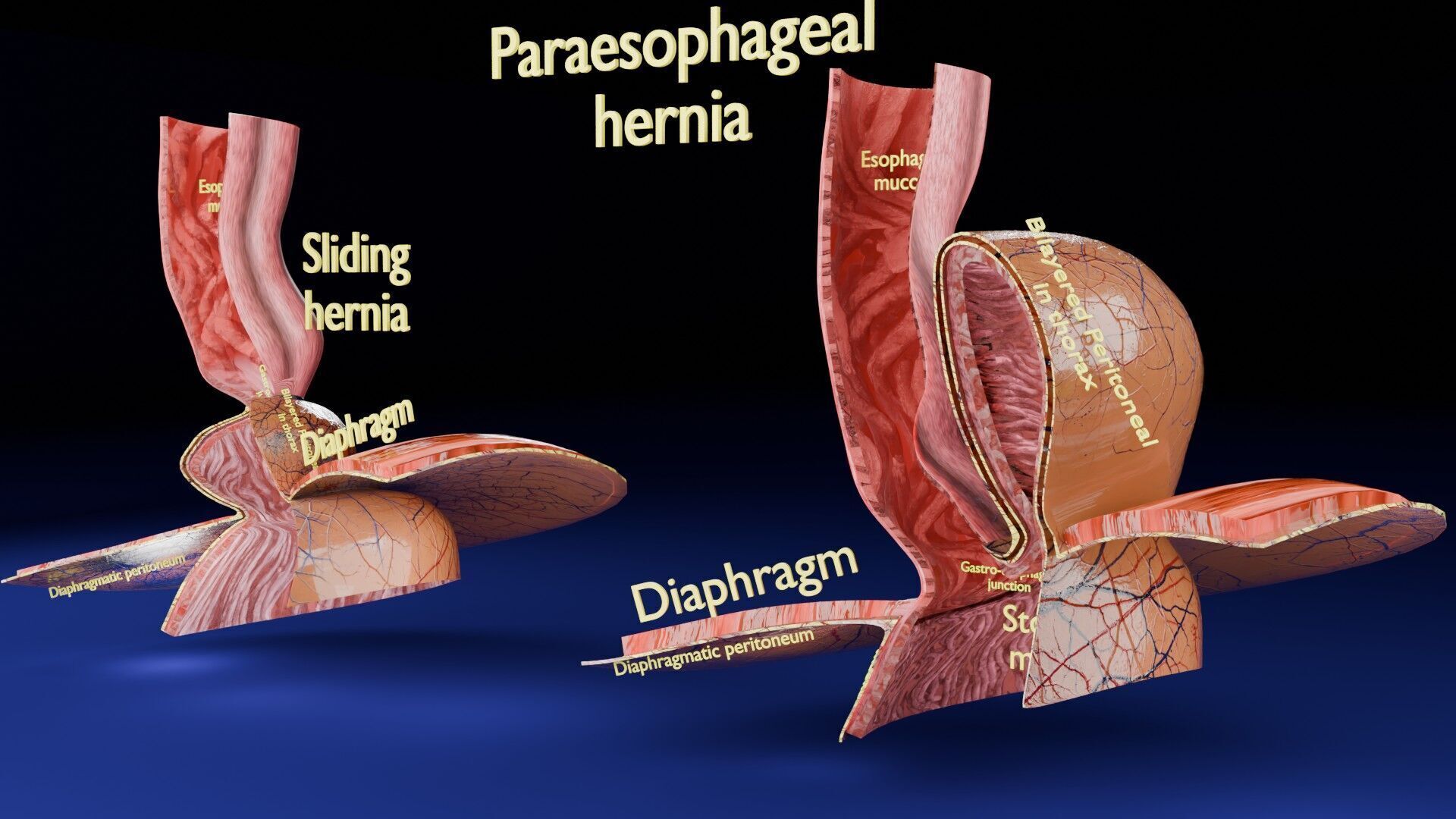 Hiatal hernia stomach sliding paraesophageal Low-poly 3D model_2