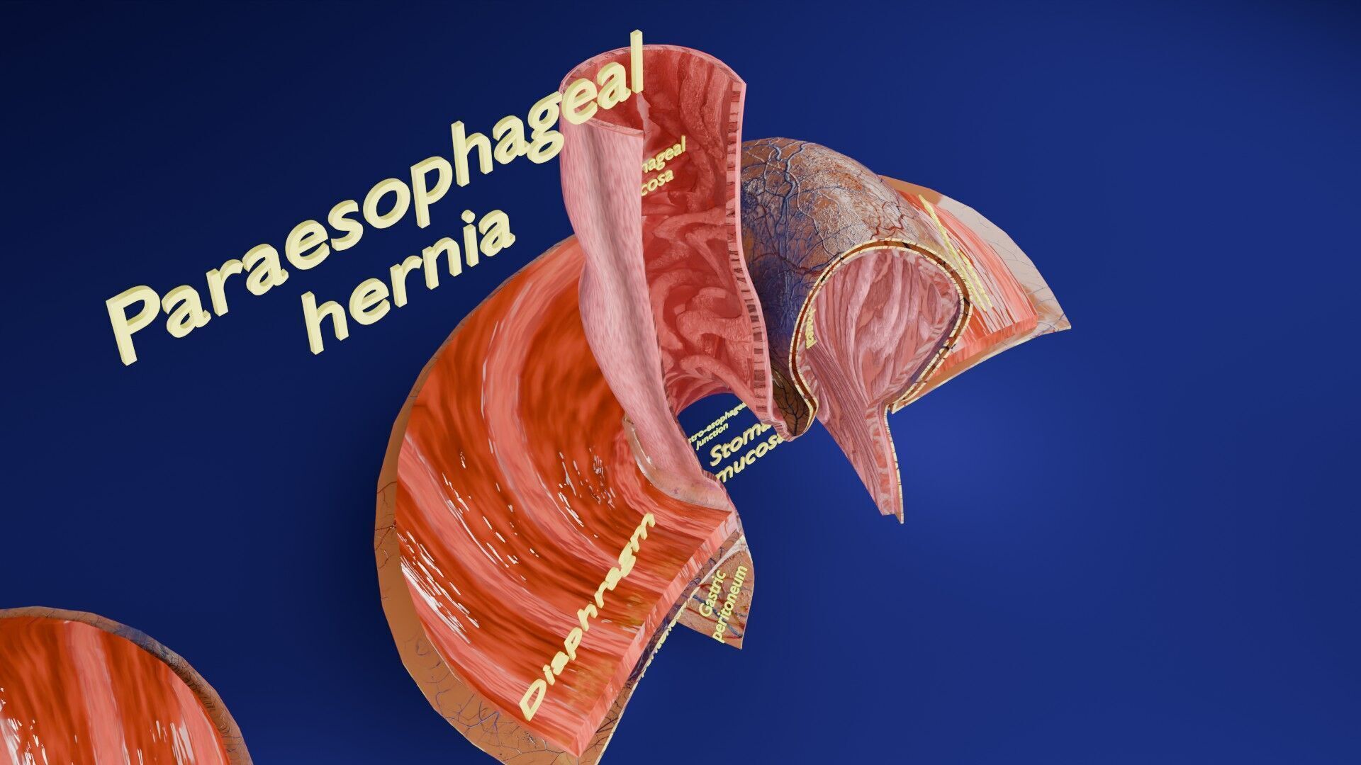 Hiatal hernia stomach sliding paraesophageal Low-poly 3D model_16