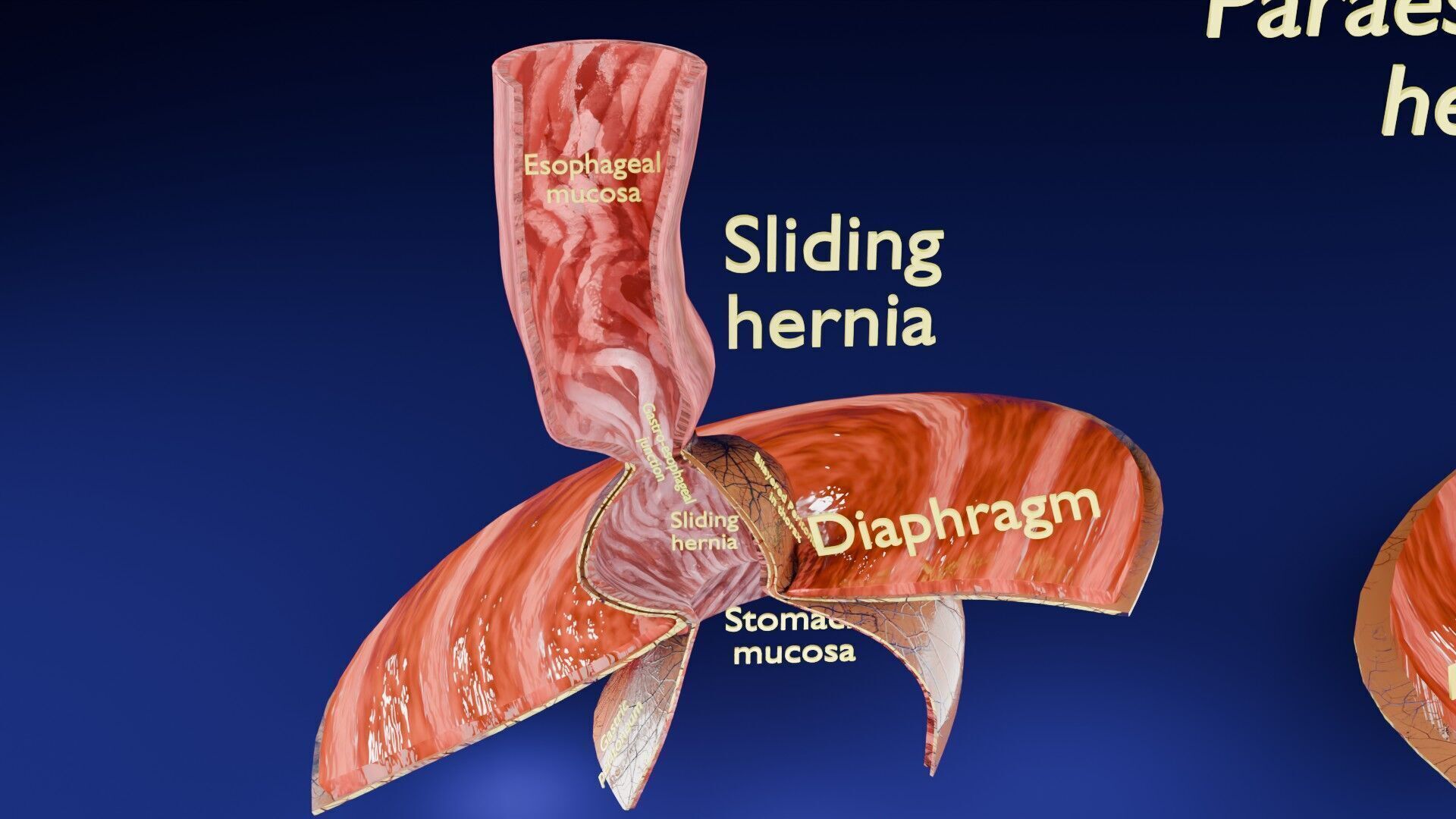 Hiatal hernia stomach sliding paraesophageal Low-poly 3D model_17