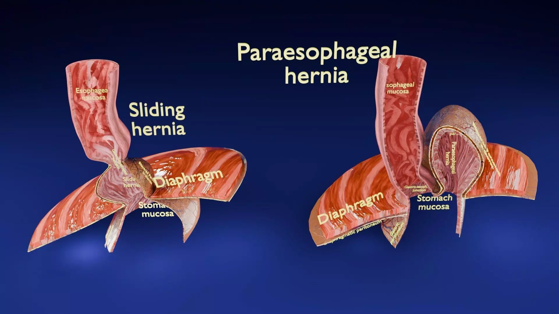 Hiatal hernia stomach sliding paraesophageal Low-poly 3D model_0