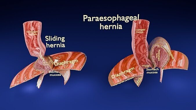 Hiatal hernia stomach sliding paraesophageal Low-poly 3D model