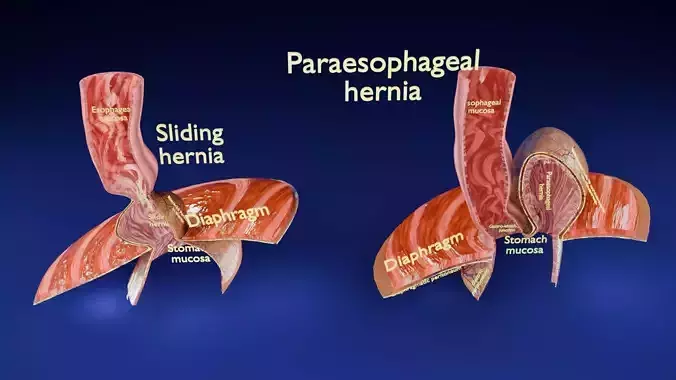 Hiatal hernia stomach sliding paraesophageal Low-poly 3D model