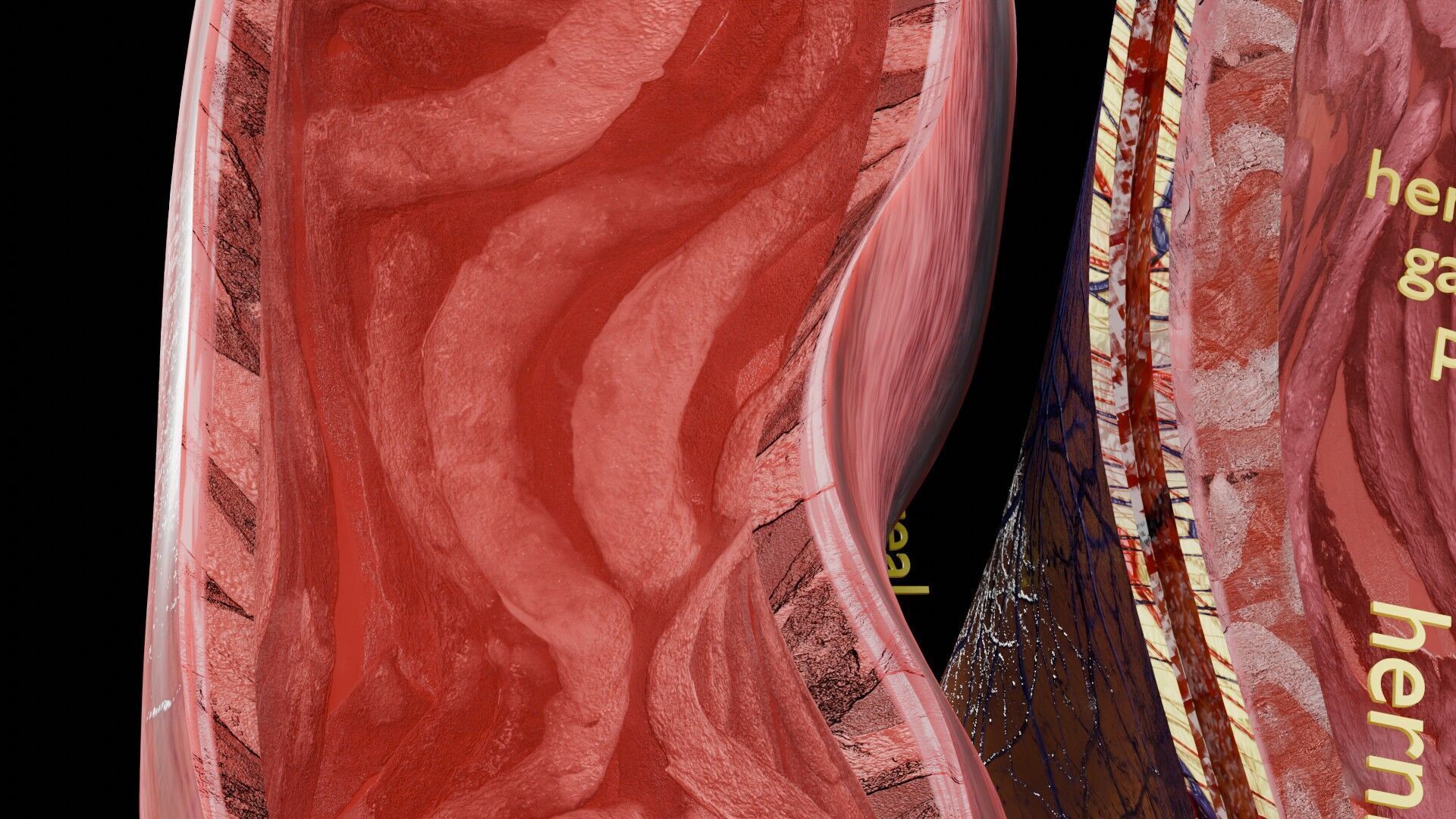 Hiatal hernia stomach sliding paraesophageal Low-poly 3D model_10