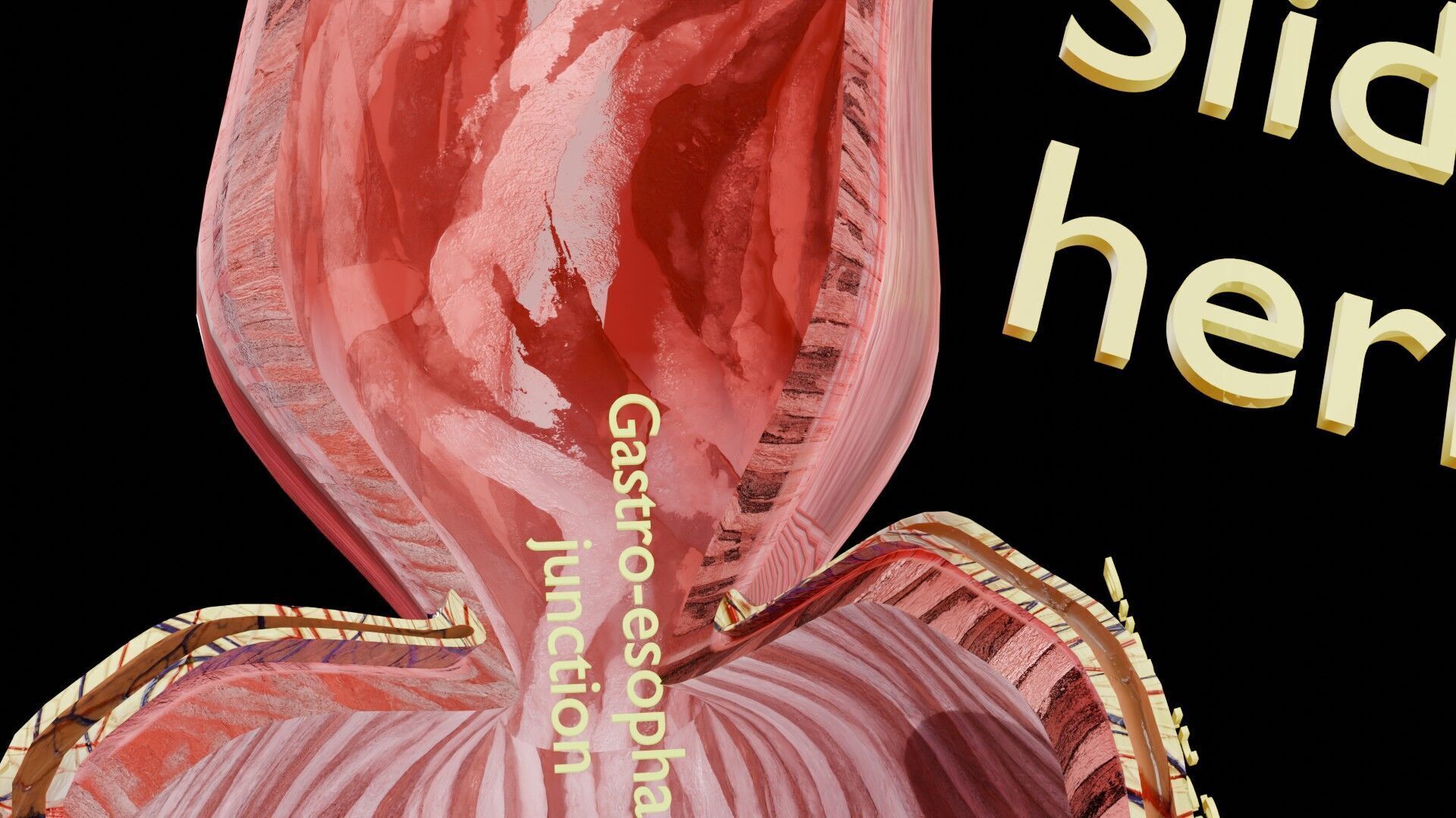 Hiatal hernia stomach sliding paraesophageal Low-poly 3D model_24