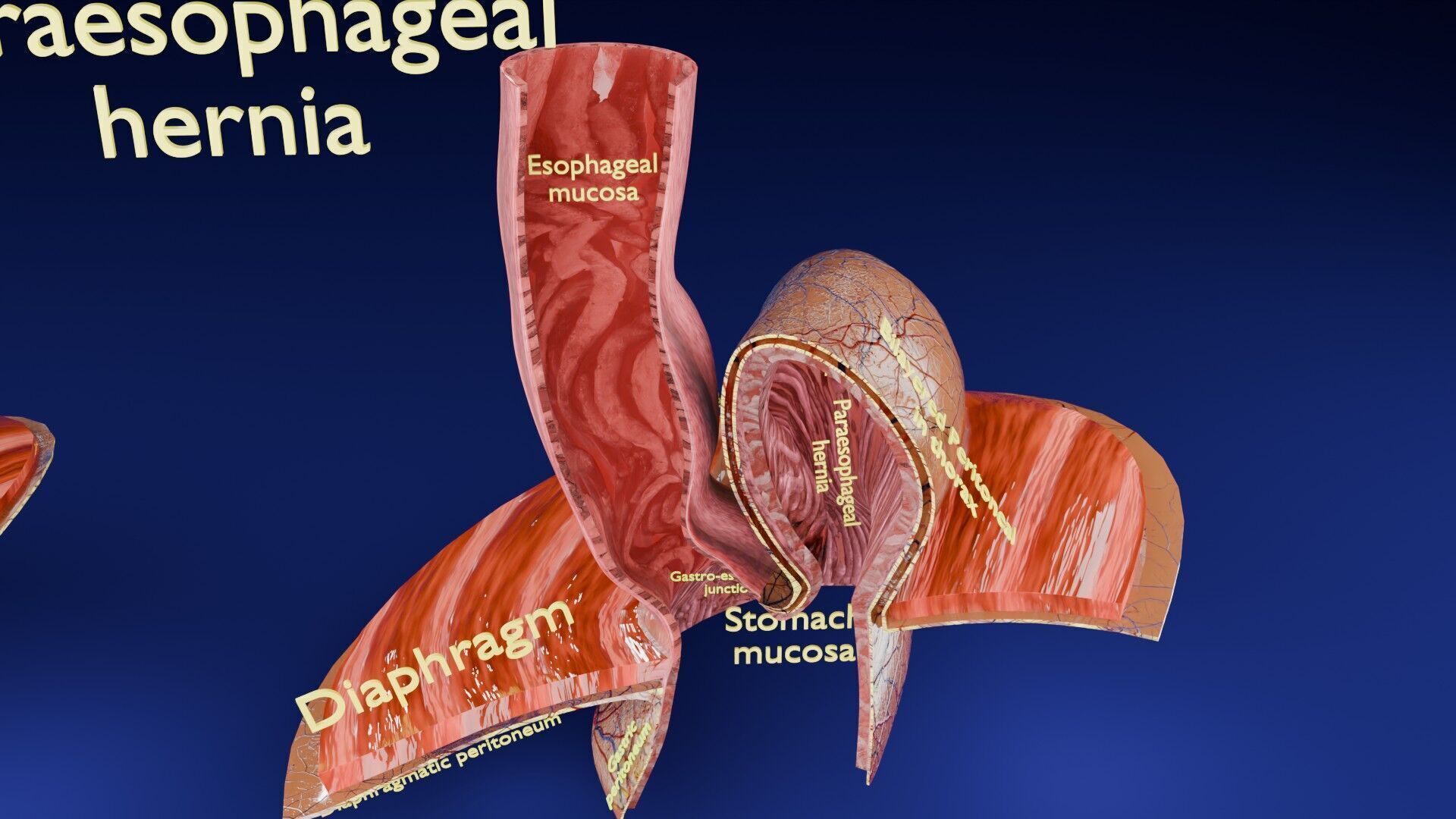 Hiatal hernia stomach sliding paraesophageal Low-poly 3D model_3
