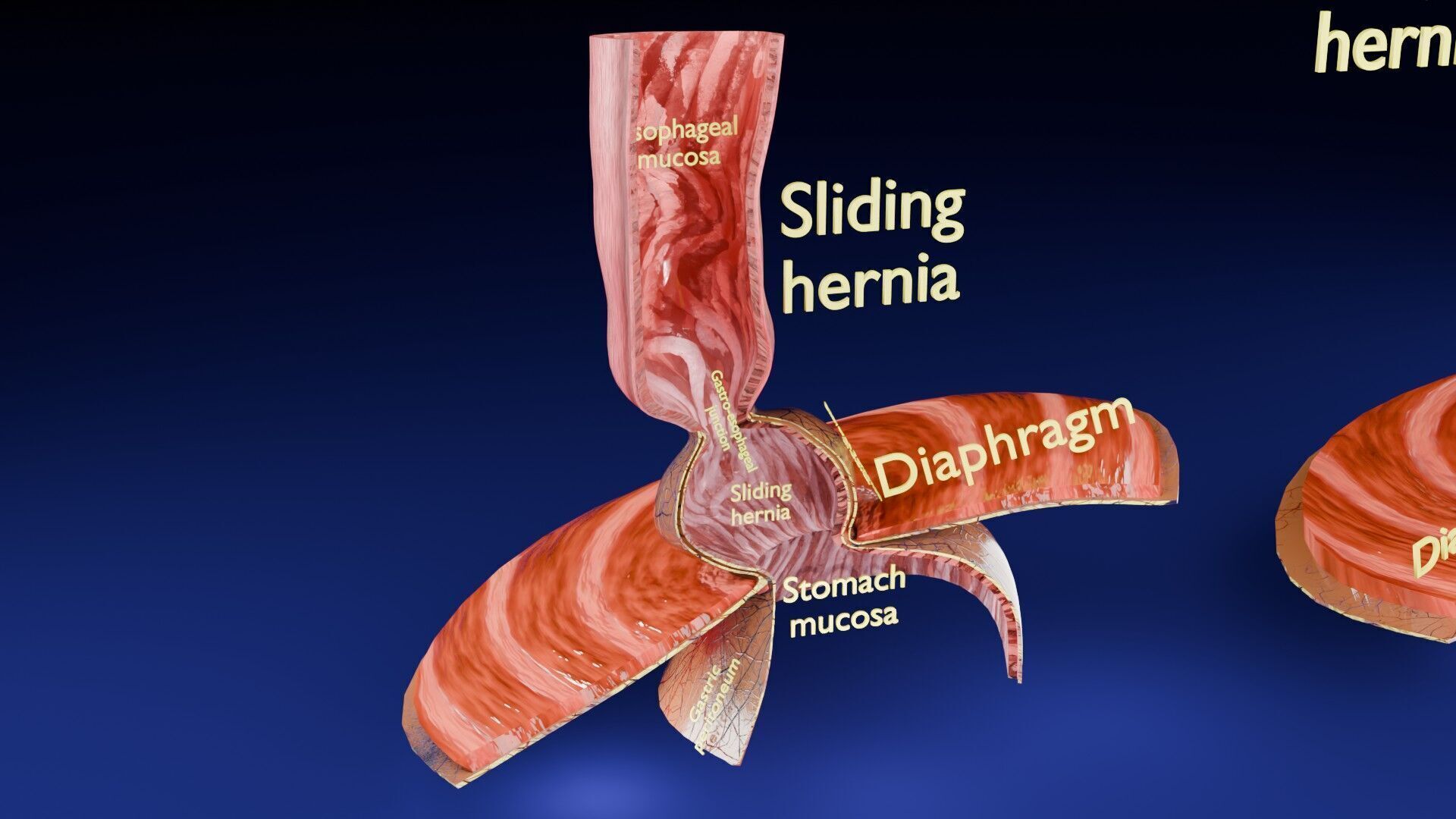 Hiatal hernia stomach sliding paraesophageal Low-poly 3D model_19