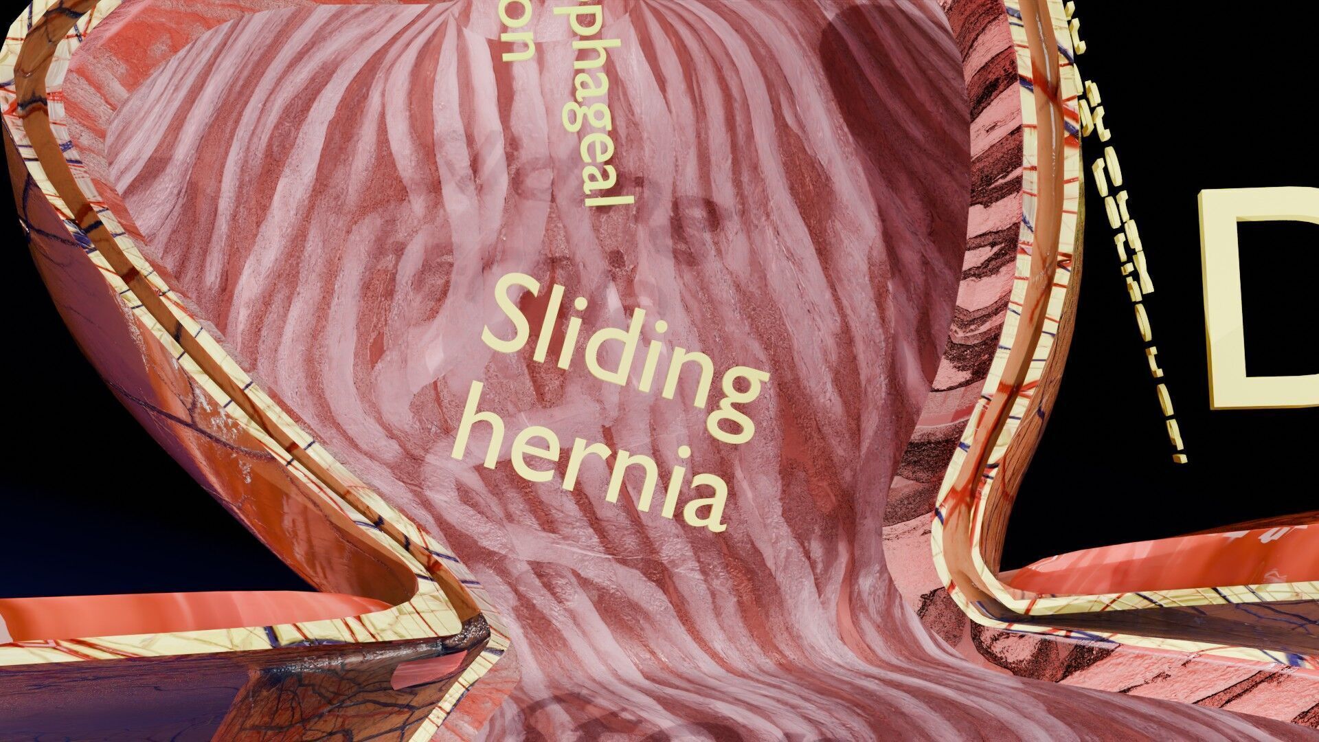 Hiatal hernia stomach sliding paraesophageal Low-poly 3D model_23